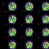 11A2 Infarct vs Demyelination (Case 11) PET 1 - Copy