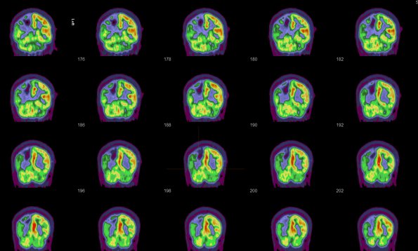 11A2 Infarct vs Demyelination (Case 11) PET 1 - Copy