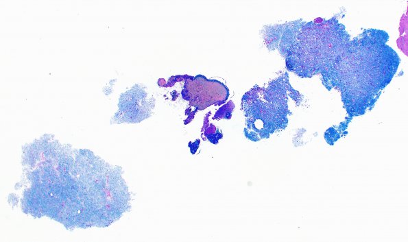 11B2 CNS Wallerian Degeneration (Case 11) LFB-PAS 2X