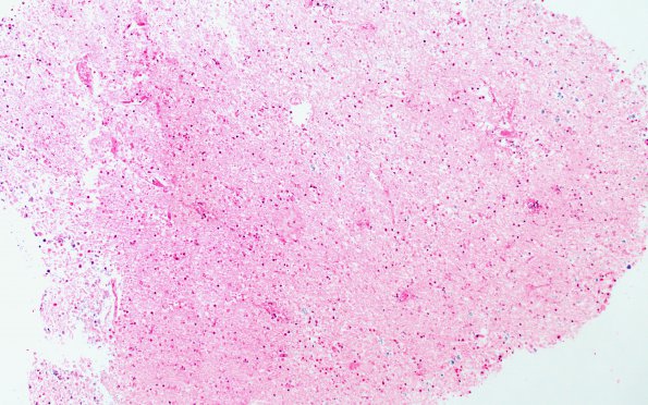 11C1 Demyelination vs Wallerian Degeneration in CNS (Case 11) H&E 10X