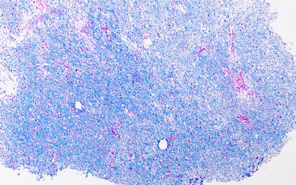 11C2 Demyelination vs Wallerian Degeneration in CNS (Case 11) LFB-PAS 10X