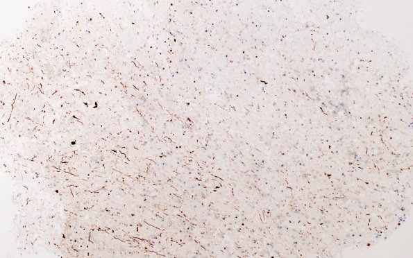 11C3 Demyelination vs Wallerian Degeneration in CNS (Case 11) NF 10X