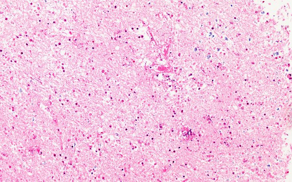 11C4 Demyelination vs Wallerian Degeneration in CNS (Case 11) H&E 20X