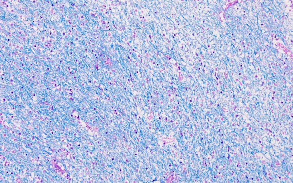 11C5 Demyelination vs Wallerian Degeneration in CNS (Case 11) LFB-PAS 20X