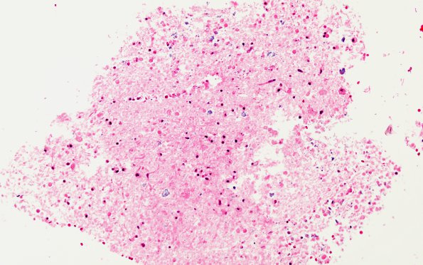 11D1 Demyelination vs Infarct-Induced CNS Wallerian Degeneration (Case 11) Area B H&E 20X