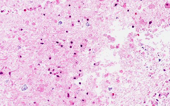 11D2 Demyelination vs Wallerian Degeneration in CNS (Case 11) Area B H&E 40X