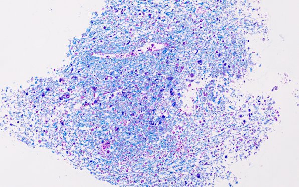 11D3 Demyelination vs Wallerian Degeneration in CNS (Case 11) Area B LFB-PAS 20X