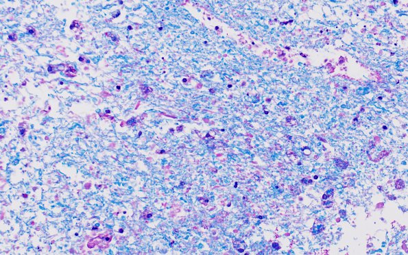 11D4 Demyelination vs Wallerian Degeneration in CNS (Case 11) Area B LFB-PAS 40X