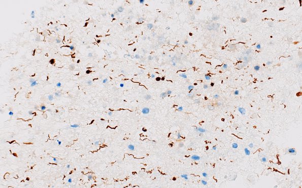 11D6 Demyelination vs Wallerian Degeneration in CNS (Case 11) Area B NF 40X