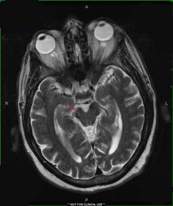 1A1 Infarct, remote w tract degeneration (Case 7) T2 1