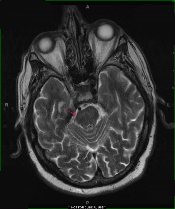 1A2 Infarct, remote w tract degeneration (Case 7) T2 2