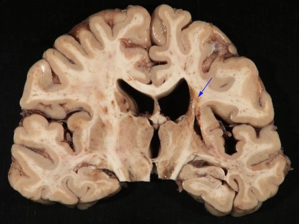 1B1 Infarct, remote w tract degeneration (Case 7)_2