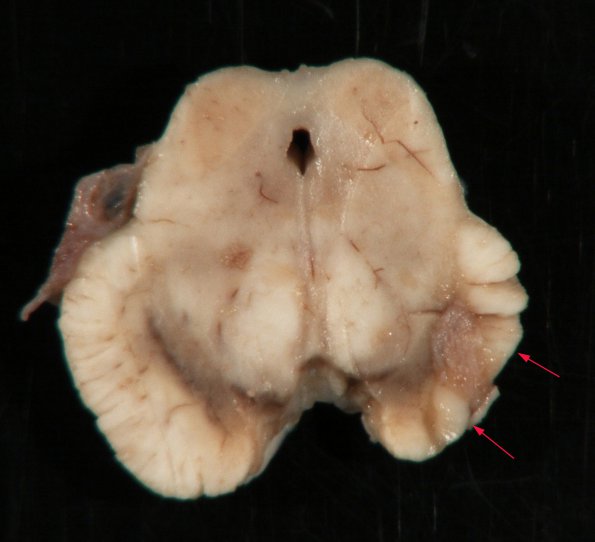 1B2 Infarct, remote w tract degeneration (Case 7)_3