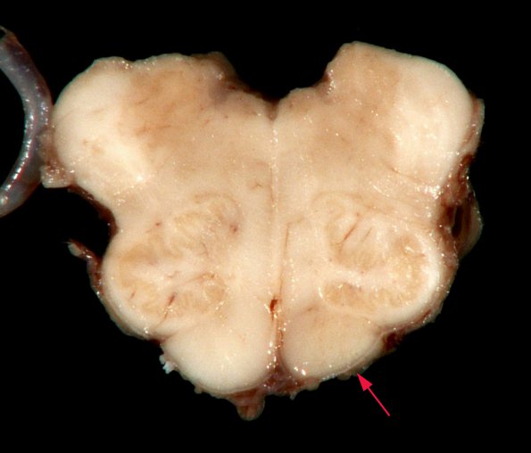 1B3 Infarct, remote w tract degeneration (Case 7)_4