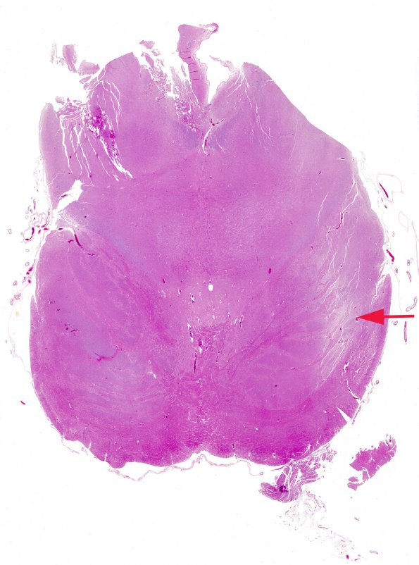 2A1 Descending Tract Degeneration (TREX Leukodystrophy, Case 3) pons H&E whole mount