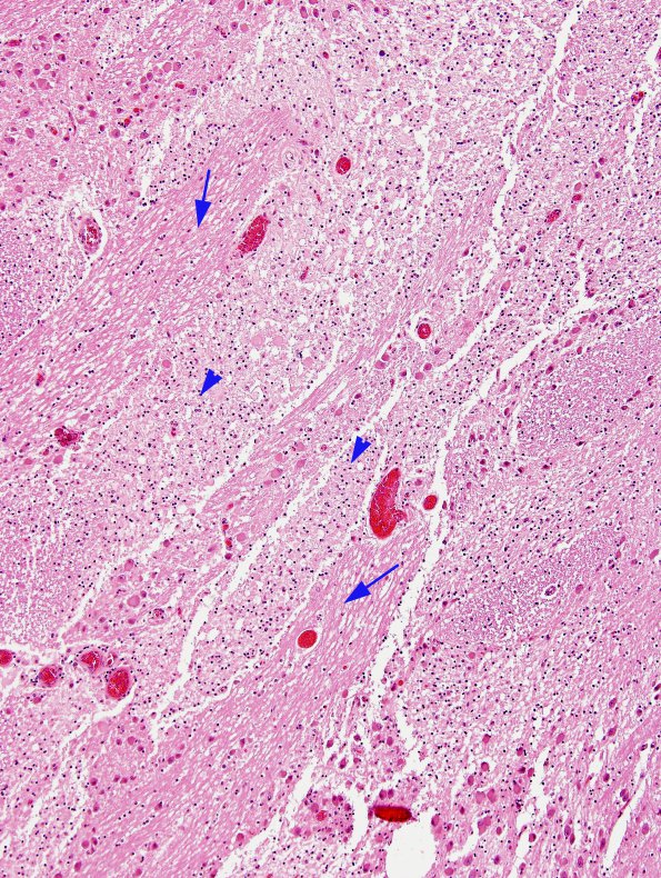 2A2 Descending Tract Degeneration (TREX Leukodystrophy, Case 3) pons H&E 10X