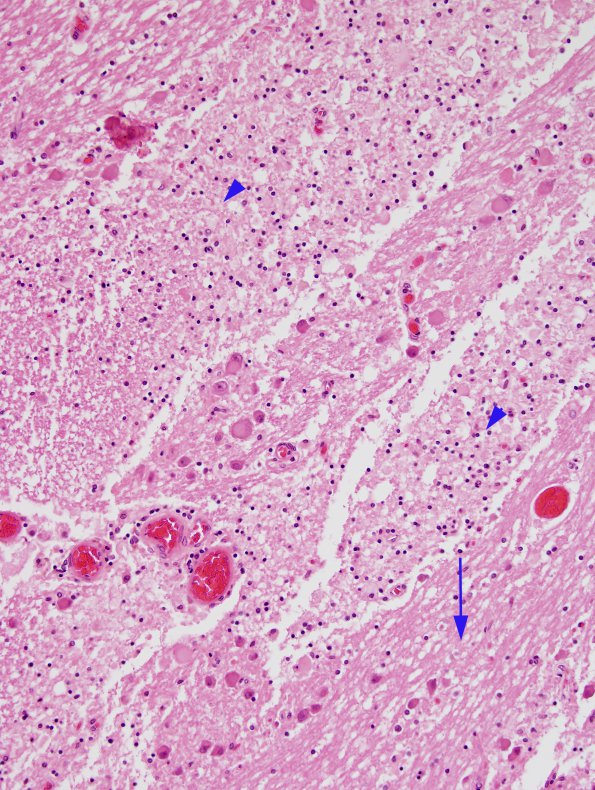 2A3 Descending Tract Degeneration (TREX Leukodystrophy, Case 3) pons H&E 20X