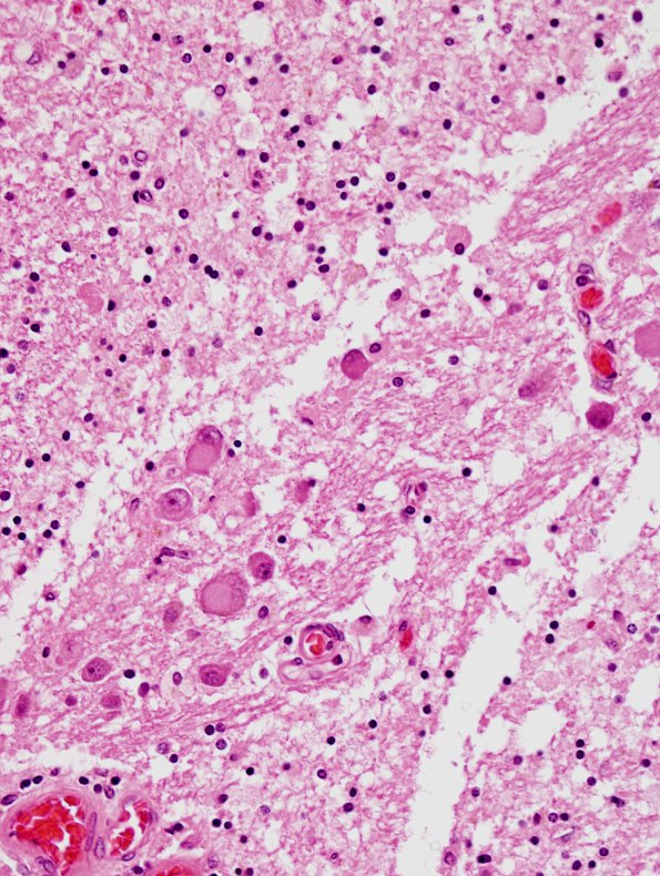 2A4 Descending Tract Degeneration (TREX Leukodystrophy, Case 3) pons H&E 40X A