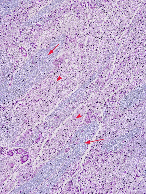 2B2 Tract Degeneration (CRV TREX, HERNS, RVCL, Case 3) pons Matched Set LFB-PAS 10X