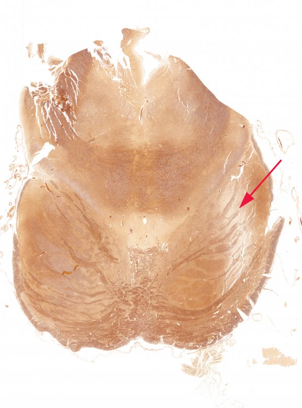 2C1 Tract Degeneration (CRV TREX, HERNS, RVCL, Case 3) 2 pons Biels whole mount