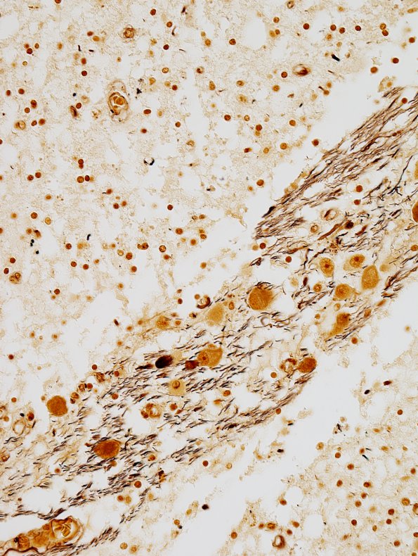 2C4 Tract Degeneration (CRV TREX, HERNS, RVCL, Case 3) pons Matched Set Biels 40X