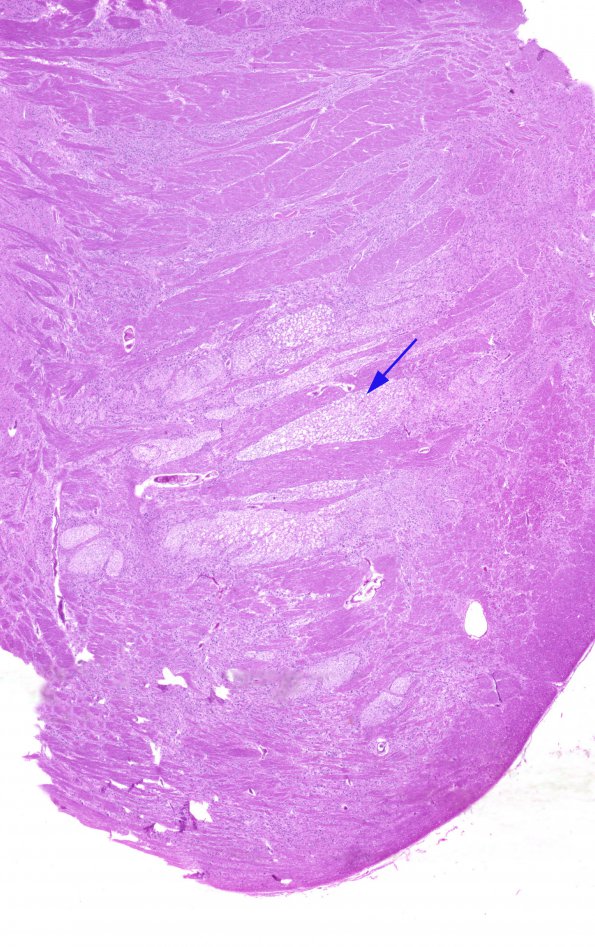 3A1 Tract Degeneration, corticospinal, Pons (Case 6, TREX1 mutant) H&E whole mount