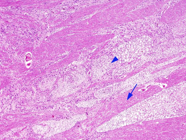 3A2 Tract Degeneration, corticospinal, Pons (Case 6, TREX1 mutant) H&E 3