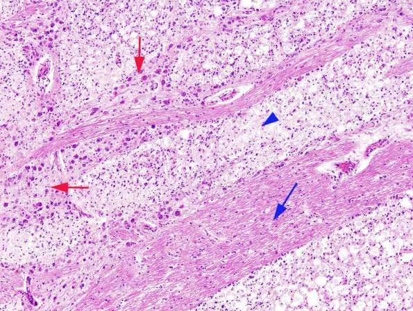 3A3 Tract Degeneration, corticospinal, Pons (Case 6, TREX1 mutant) H&E 2