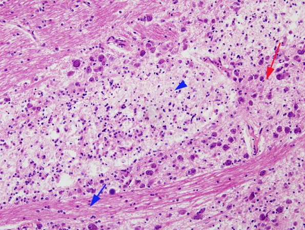 3A4 Tract Degeneration, corticospinal, Pons (Case 6, TREX1 mutant) H&E 1