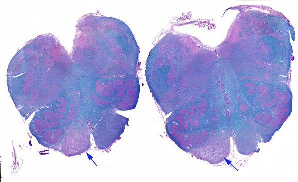 4B1 Tract Degeneration (Case 1) LFB-PAS 2