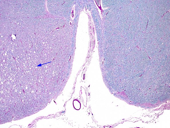 4B2 Tract Degeneration (Case 1) LFB-PAS 4XA