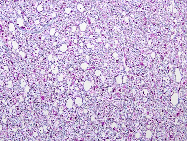 4B3 Tract Degeneration (Case 1) LFB-PAS 20X Abnormal