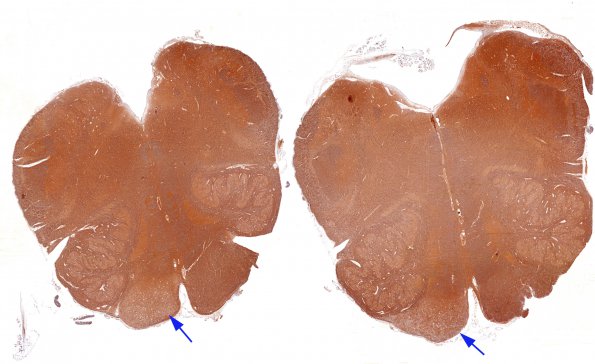 4C1 case 1 Tract Degeneration (Case 1) NF 2