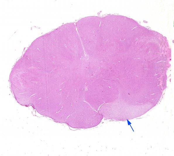 5A1 Tract Degeneration (Pontine infarct (Case 4) H&E whole mounta