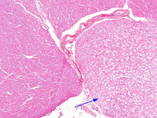 5A2 Tract Degeneration (Pontine infarct (Case 4) H&E 2