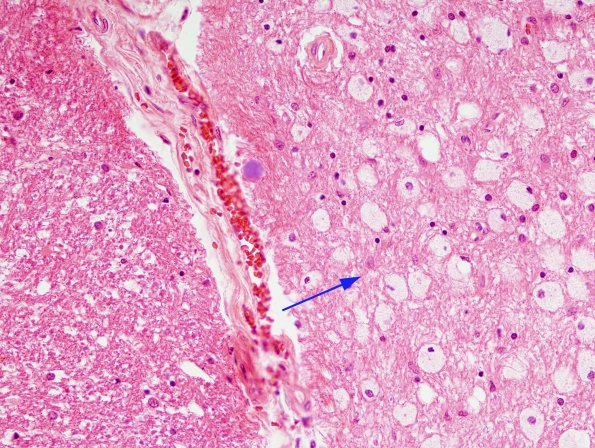 5A3 Tract Degeneration (Pontine infarct (Case 4) H&E 1