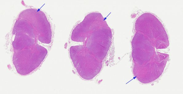 6A1 Tract Degeneration, corticospinal (Case 5) 1 H&E whole mount