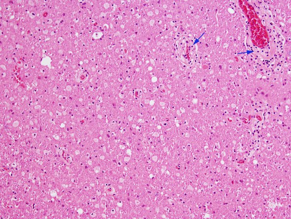 6A3 Tract Degeneration, corticospinal (Case 5) H&E 20X