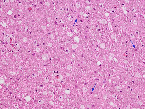 6A4 Tract Degeneration, corticospinal (Case 5) H&E 40X