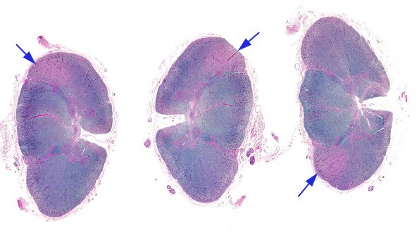 6B1 Tract Degeneration, corticospinal (Case 5) 1 LFB-PAS whole mount