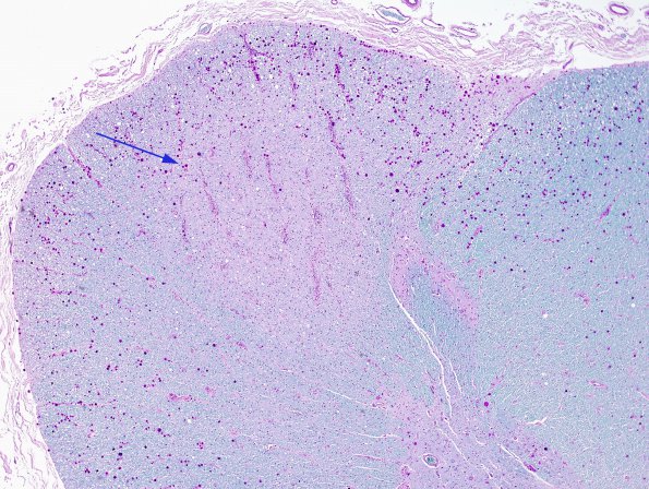 6B2 Tract Degeneration, corticospinal (Case 5) LFB-PAS 4X