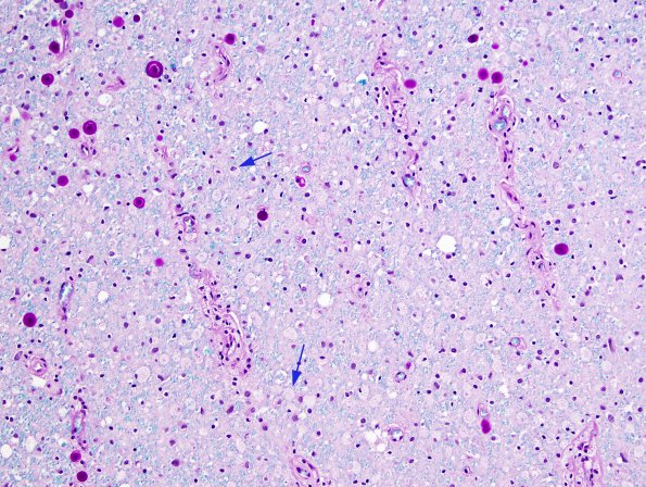 6B3 Tract Degeneration, corticospinal (Case 5) LFB-PAS 20X