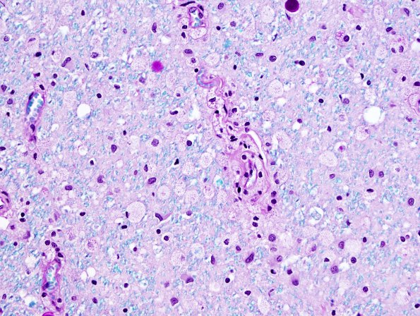 6B4 Tract Degeneration, corticospinal (Case 5) LFB-PAS 40X