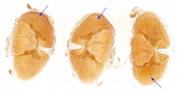 6C1 Tract Degeneration, corticospinal (Case 5) 1 Bielschowsky whole mount