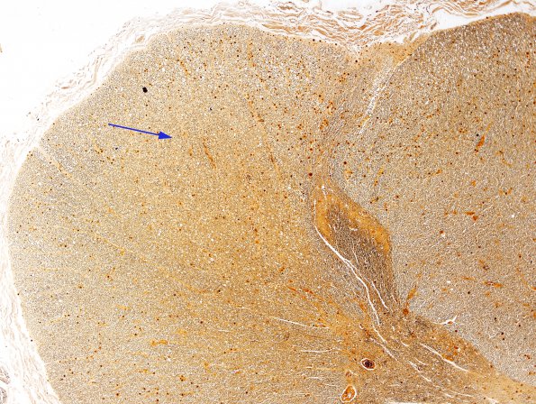 6C2 Tract Degeneration, corticospinal (Case 5) Biels degenerated side 4X