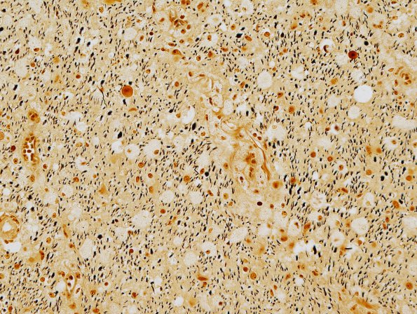 6C4 Tract Degeneration, corticospinal (Case 5) Biels degenerated side 40X