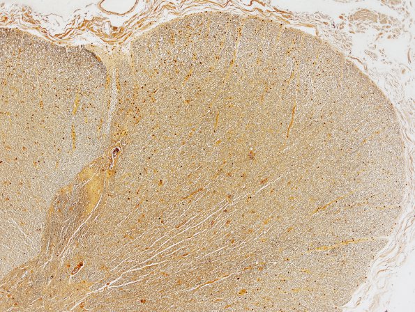 6C5 Tract Degeneration, corticospinal (Case 5) Biels normal side 4X