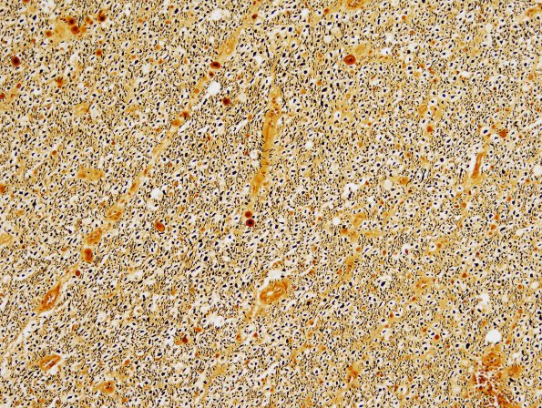 6C6 Tract Degeneration, corticospinal (Case 5) Biels normal side 20X