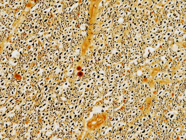 6C7 Tract Degeneration, corticospinal (Case 5) Biels normal side 40X