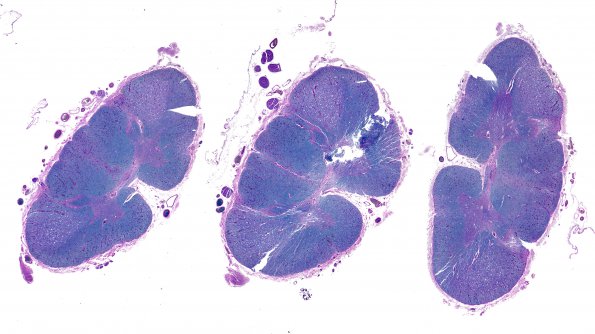 7B Tract Degeneration (Case 2) LFB-PAS whole mount